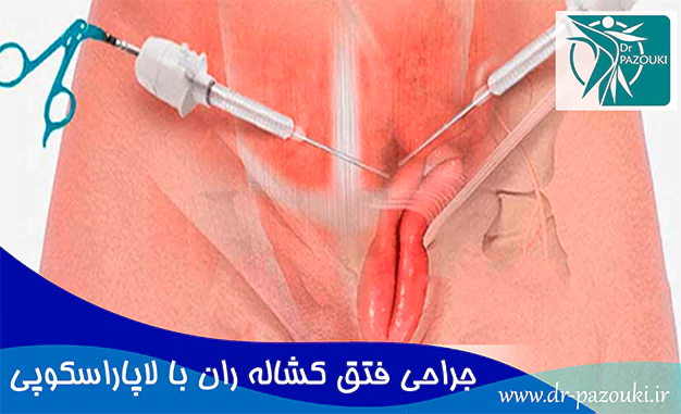 جراحی فتق کشاله ران با لاپاراسکوپی