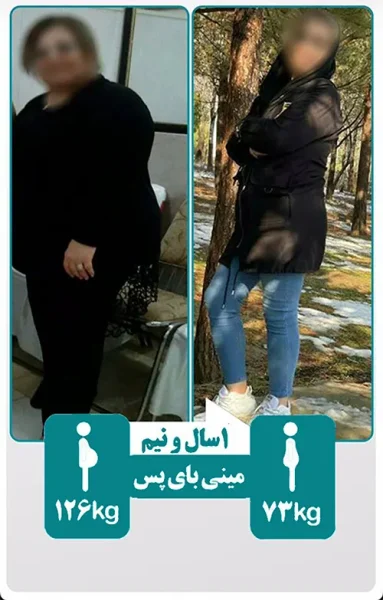 قبل و بعد جراحی چاقی