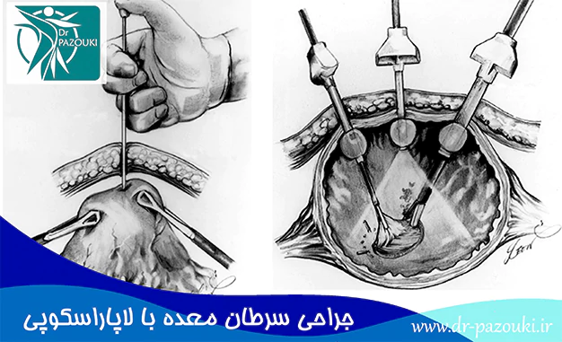 جراحی سرطان معده با لاپاراسکوپی