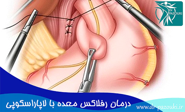 درمان رفلاکس معده با روش لاپاراسکوپی