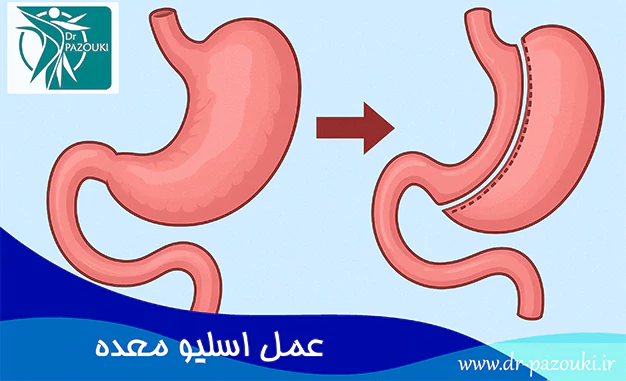 عمل اسلیو معده
