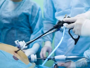 عمل سرطان معده با لاپاراسکوپی