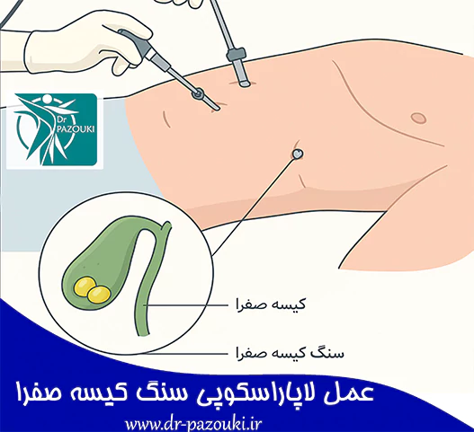 عمل لاپاراسکوپی سنگ کیسه صفرا