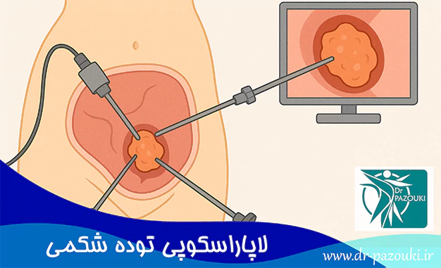 لاپاراسکوپی توده شکمی