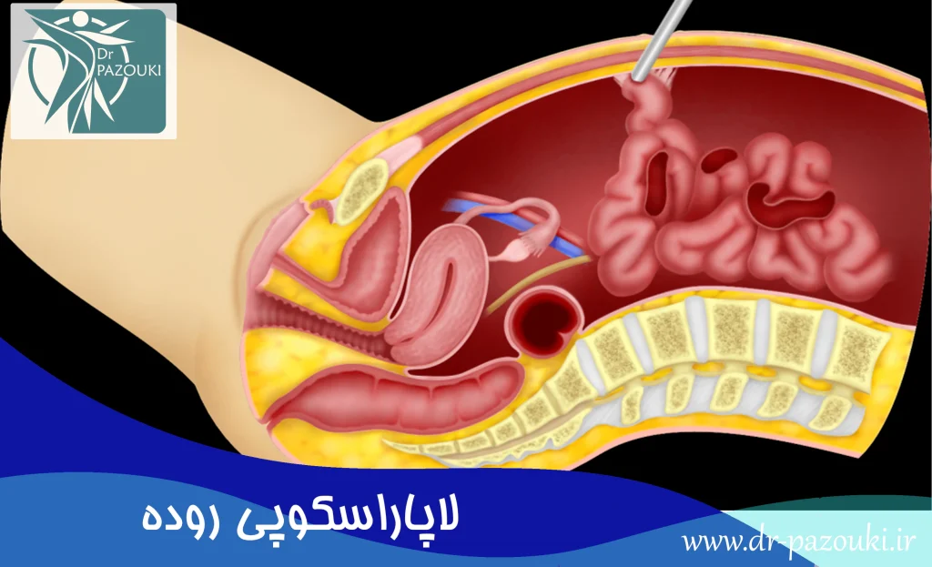 لاپاراسکوپی روده
