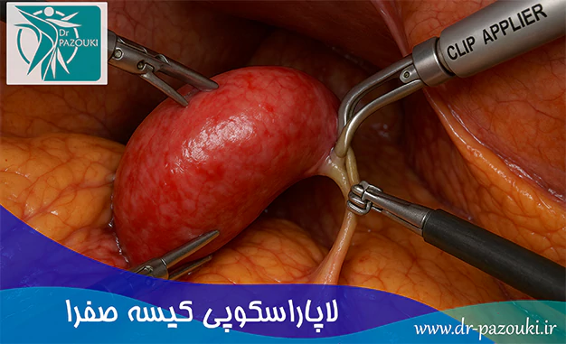 لاپاراسکوپی کیسه صفرا