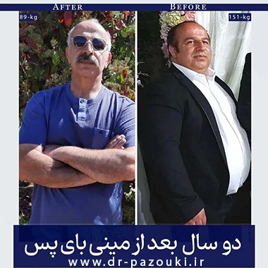 عمل مینی بای پس معده