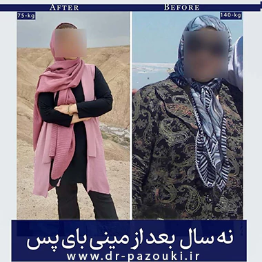 قبل و بعد مینی بای پس