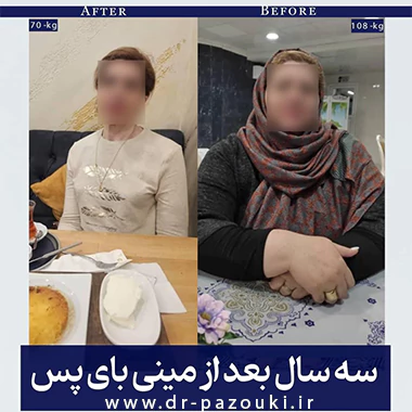مینی بای پس معده