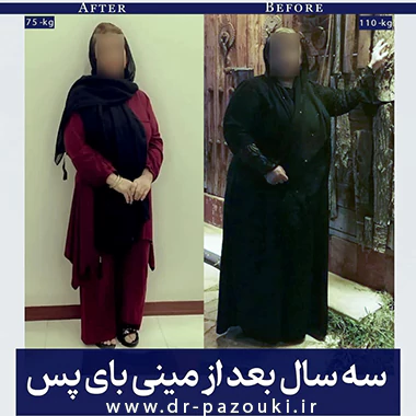 مینی بای پس