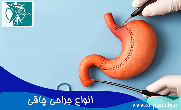 انواع جراحی چاقی انواع جراحی چاقی