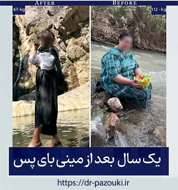 عکس قبل و بعد جراحی چاقی