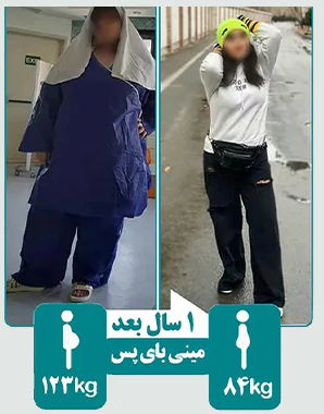 قبل و بعد مینی بای پس معده