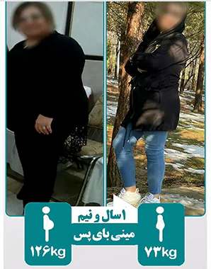 نتیجه عمل مینی بای پس معده