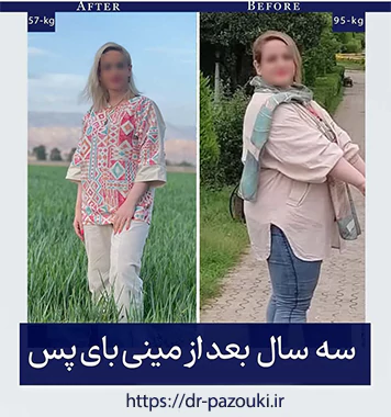 نمونه کار قبل و بعد جراحی چاقی