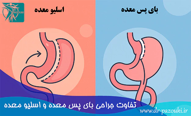 تفاوت جراحی بای پس معده و اسلیو معده تفاوت جراحی بای پس معده و اسلیو معده