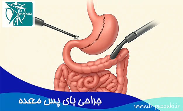 جراحی بای پس معده