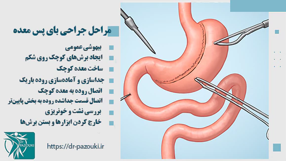 مراحل جراحی بای پس معده مراحل جراحی بای پس معده