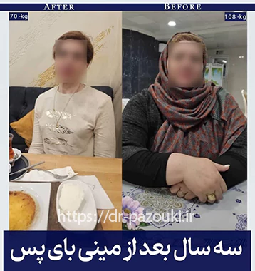 نتیجه عمل بهترین جراح چاقی نتیجه عمل بهترین جراح چاقی