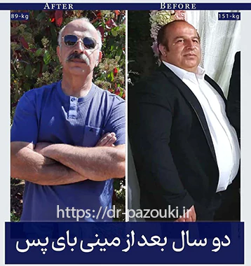 نمونه کار بهترین جراح چاقی نمونه کار عمل بهترین جراح چاقی دکتر پازوکی