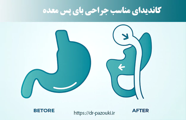 کاندیدای مناسب جراحی بای پس معده کاندیدای مناسب جراحی بای پس معده