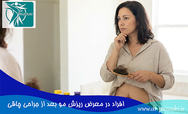 افراد در معرض ریزش مو بعد از جراحی چاقی افراد در معرض ریزش مو بعد از جراحی چاقی