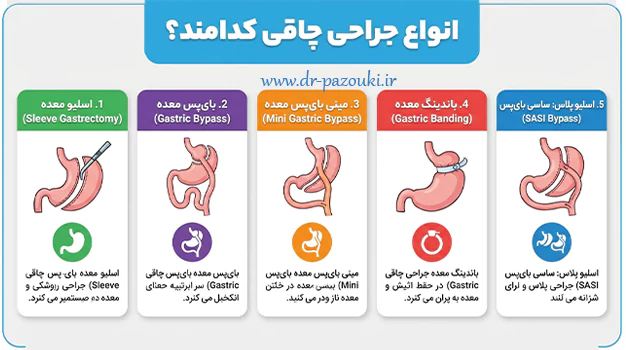 انواع جراحی چاقی کدامند؟