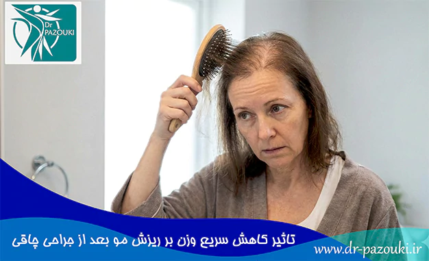 تاثیر کاهش سریع وزن بر ریزش مو بعد از جراحی چاقی تاثیر کاهش سریع وزن بر ریزش مو بعد از جراحی چاقی