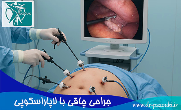 جراحی چاقی با لاپاراسکوپی