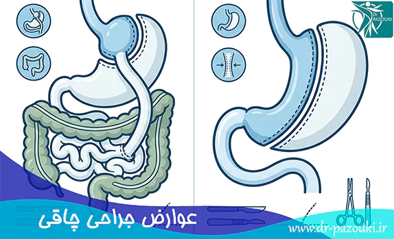 عوارض جراحی چاقی