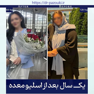 قبل و بعد جراحی چاقی با لاپاراسکوپی قبل و بعد جراحی چاقی با لاپاراسکوپی