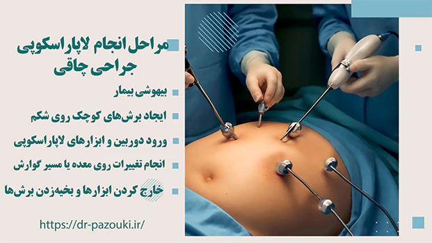 مراحل انجام جراحی لاپاراسکوپی چاقی
