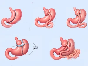 مقایسه انواع جراحی چاقی