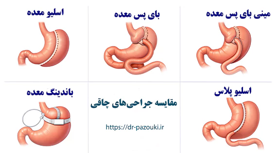 مقایسه جراحی های چاقی