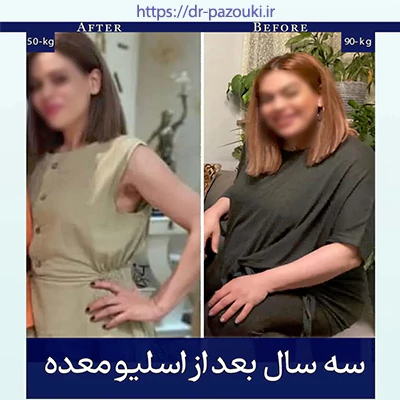 نتیجه جراحی چاقی با لاپاراسکوپی نتیجه جراحی چاقی با لاپاراسکوپی