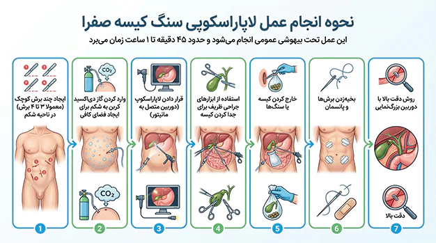 نحوه انجام عمل لاپاراسکوپی سنگ کیسه صفرا نحوه انجام عمل لاپاراسکوپی سنگ کیسه صفرا