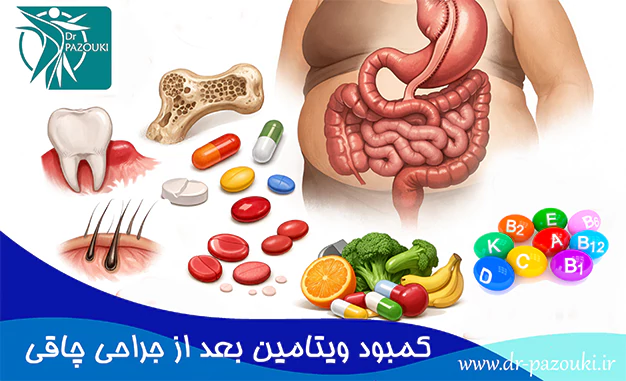 کمبود ویتامین بعد از جراحی چاقی کمبود ویتامین بعد از جراحی چاقی